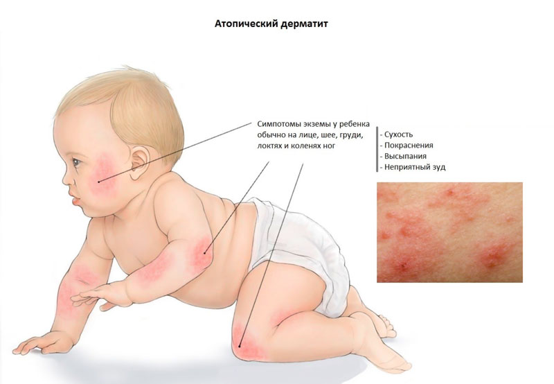 атопический дерматит у детей